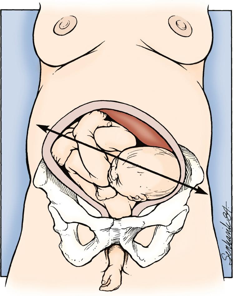 Fig. 17.4, Fetus Lying in an Oblique Axis With an Arm Prolapsing.