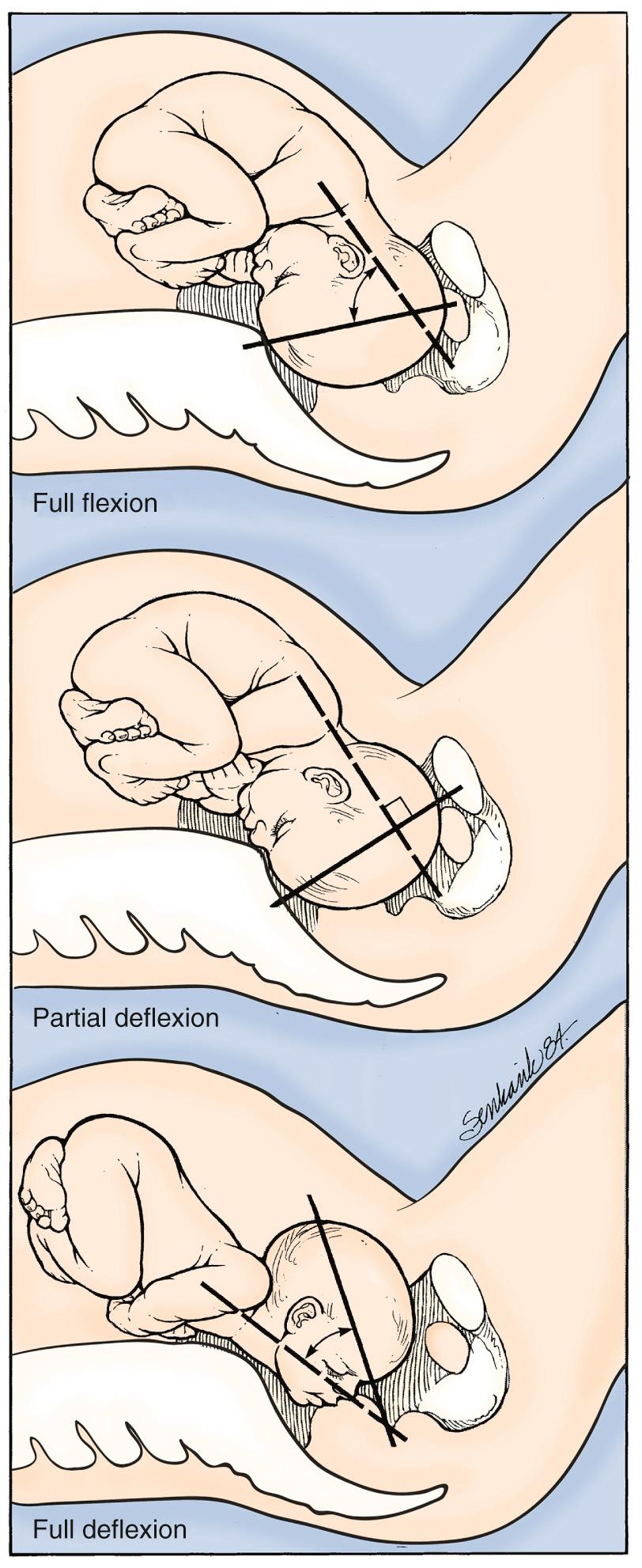 Fig. 17.5, Normal “Attitude.”