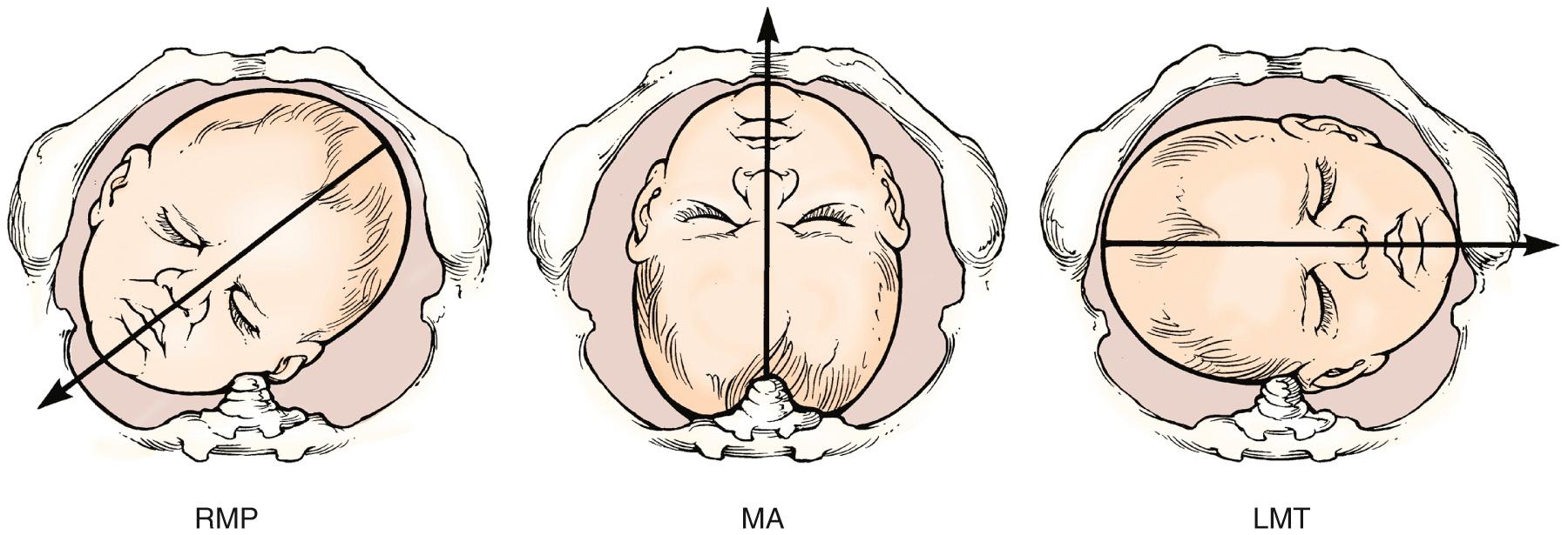 Fig. 17.7, The Point of Designation From Digital Examination in the Case of a Face Presentation is the Fetal Chin Relative to the Maternal Pelvis.