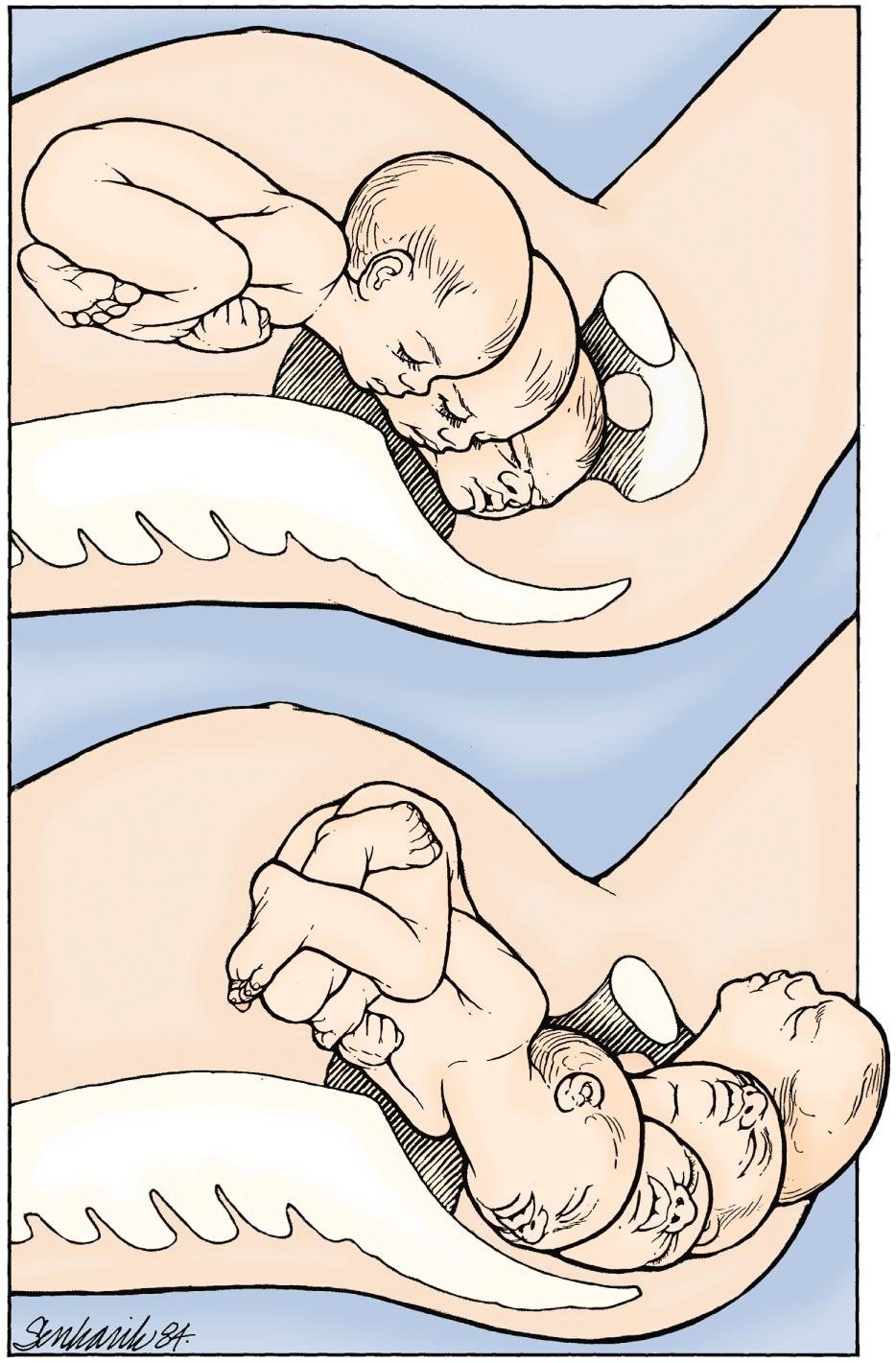 Fig. 17.9, Engagement, descent, and internal rotation remain cardinal elements of vaginal delivery in the case of a face presentation, but successful vaginal delivery of a term-size fetus presenting a face generally requires delivery by flexion under the symphysis from a mentum anterior position, as illustrated here.