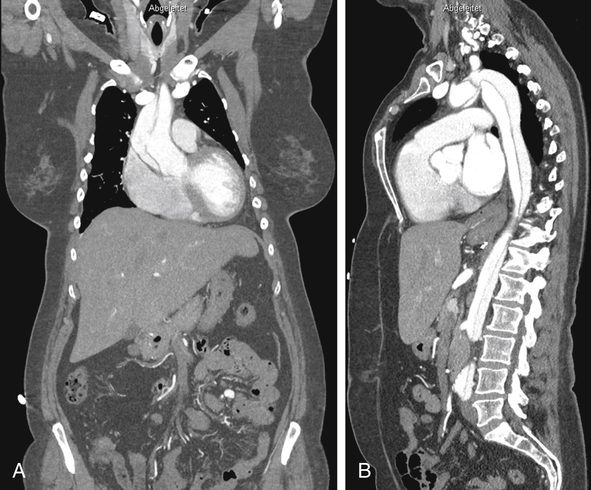 Fig. 52.1, (A)Type A aortic dissection showing an entry tear in the right lateral wall of the ascending aorta. (B) Extension of the dissection into the aortic arch and the descending and the abdominal aorta.