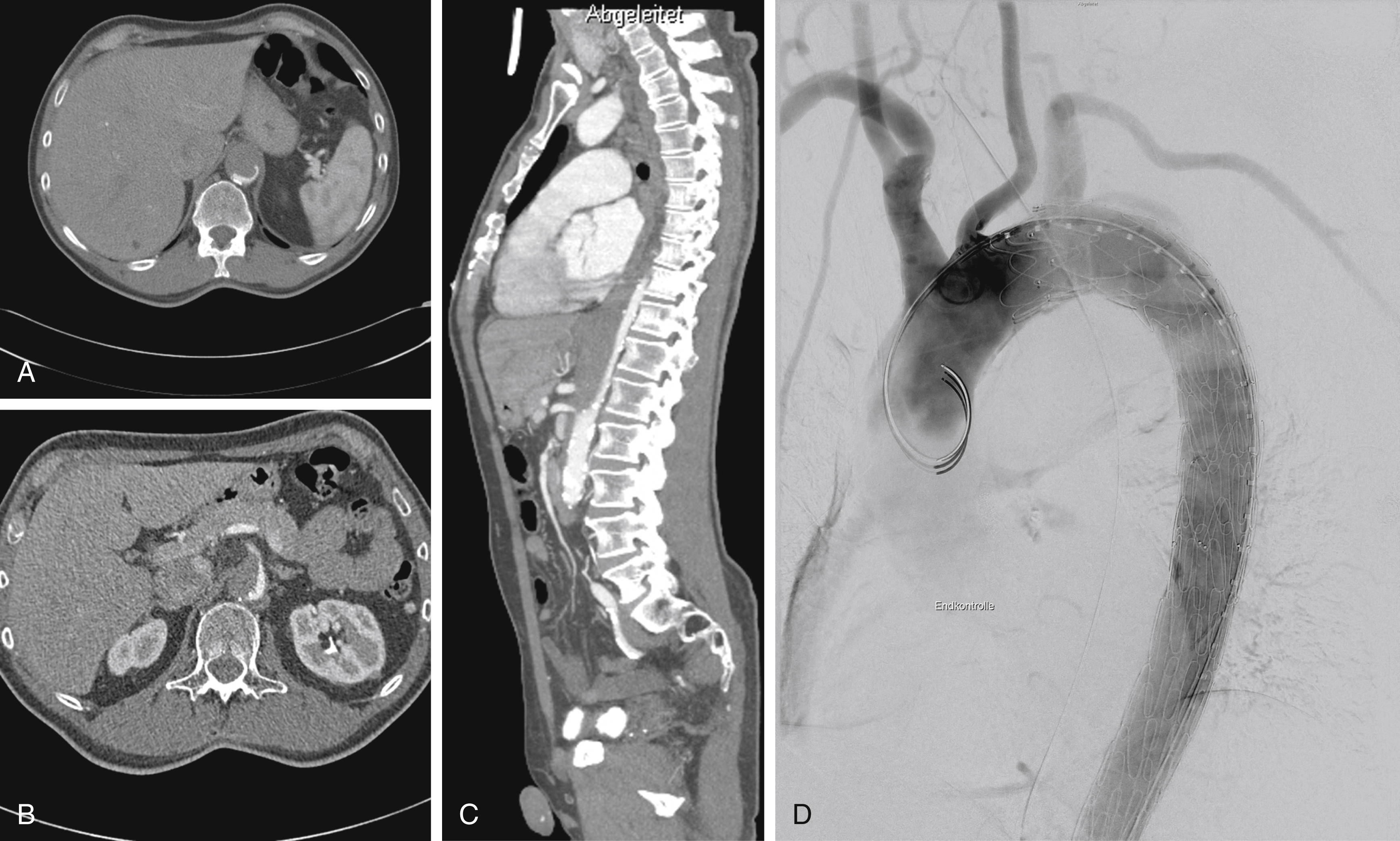 Fig. 52.2, Axial CT images of a patient with a type B aortic dissection showing thrombosis of the dilated false lumen (ventrally and right ventrolaterally placed) causing severe compromise of blood flow in the celiac axis (A) and the superior mesenteric artery (B). Sagittal reconstruction showing the severely compromised, dorsally placed true lumen (C). Widening of the true lumen after stent-graft placement in the descending aorta (D) leading to improved perfusion of the abdominal vessels; note the opacification of the celiac axis and the superior mesenteric artery (E). (F), (G), and (H) Axial and sagittal computed tomography sections corresponding, respectively, to (A), (B), and (C) at 3 months follow-up, showing pronounced widening of the true lumen and markedly improved visceral perfusion.