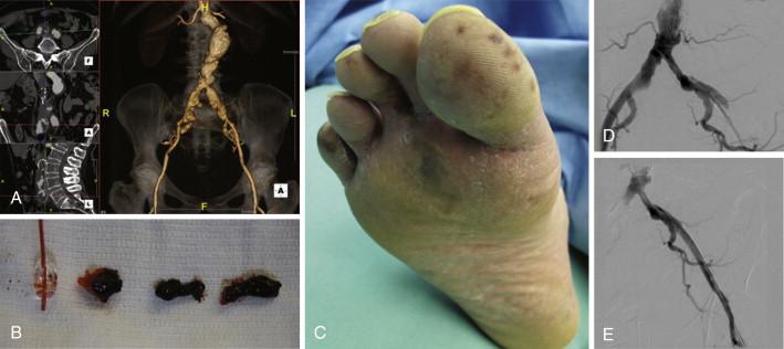 FIGURE 1, A, Heavy thrombus burden in a patient with aortoiliac aneurysm disease. B, Balloon embolectomy catheter with macroembolic thrombus retrieved from the iliofemoral arterial segment. C, Forefoot skin lesions indicating microembolism. D, External iliac artery dissection and complete occlusion following endovascular aneurysm repair. E, Patency restored with placement of self-expanding stent.