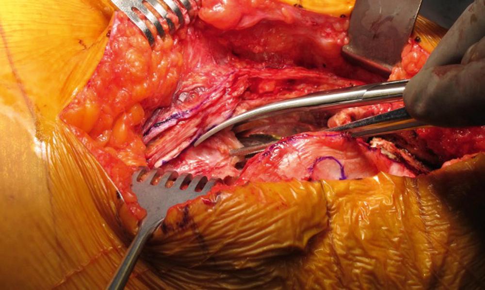 Fig. 27.1, Irrigation and debridement for acute postoperative periprosthetic joint infection. Intraoperative photograph demonstrating the interval between the joint capsule and synovium.