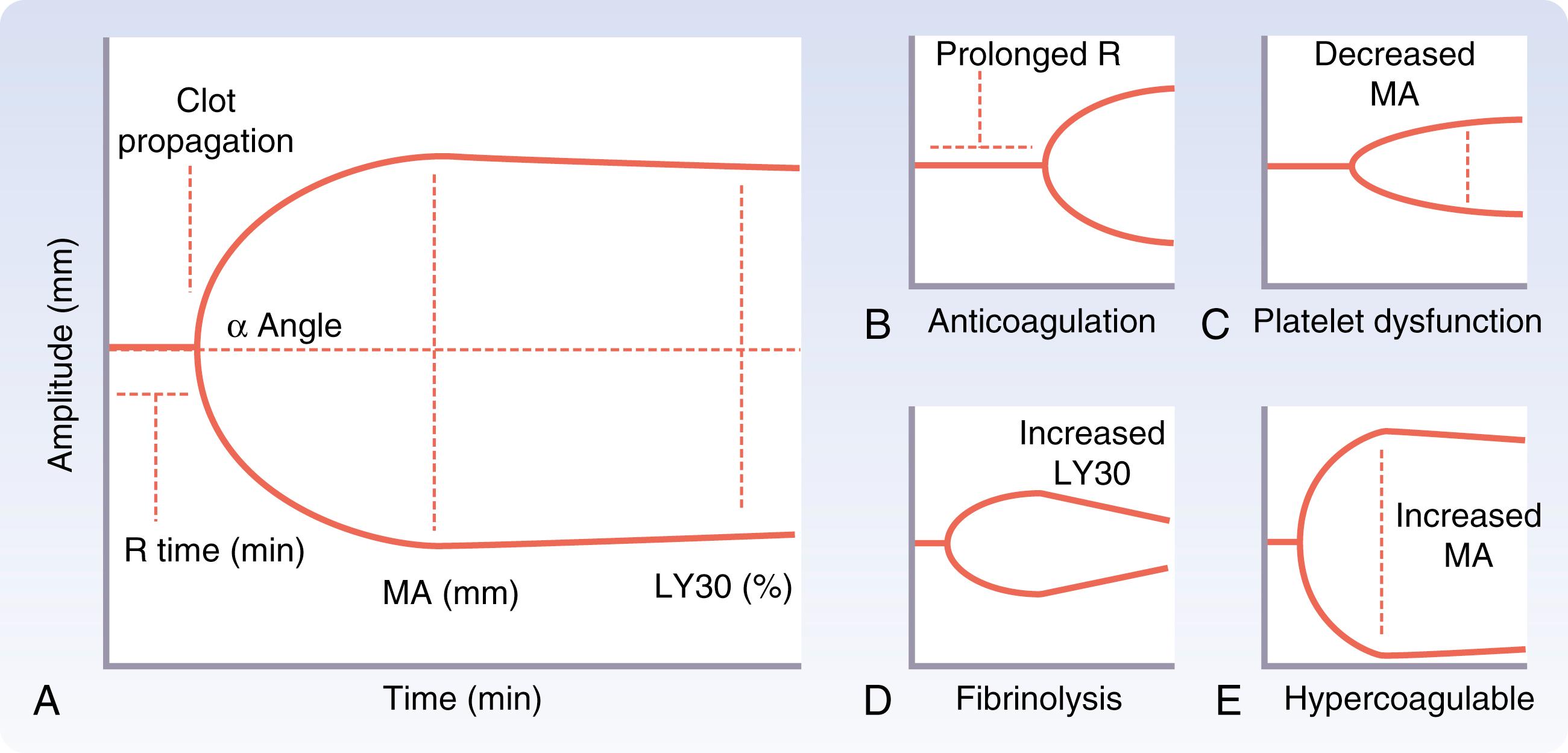 Fig. 17.7, Thromboelastogram (TEG) with standard parameters and pathologies. (A) Normal TEG. (B) Delayed clot formation with prolonged R time, treated with plasma transfusion. (C) Decreased maximum amplitude with low platelet function, treated with platelet transfusion. (D) Elevated LY30 representing fibrinolysis, treated with tranexamic acid. (E) Decreased R time and elevated MA representing hypercoagulable state. α Angle , Clot formation/polymerization; LY30 , percent amplitude decrease at 30 minutes, index of clot breakdown (lysis); MA , maximum amplitude, clot strength; R time , time to clot formation.