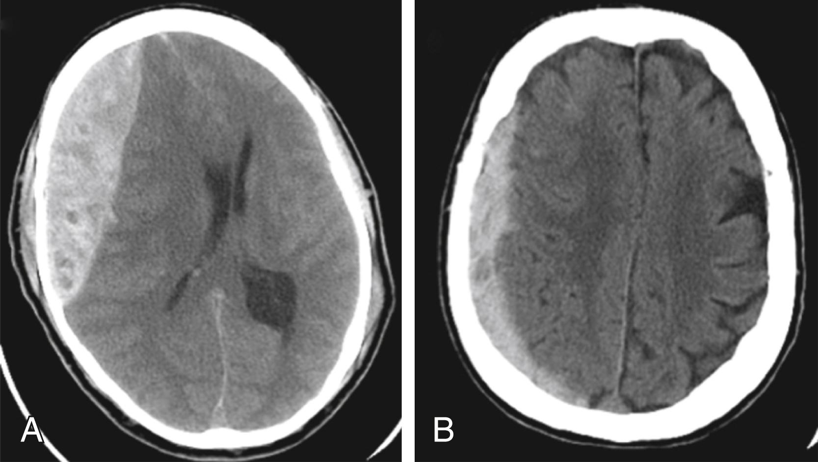 Fig. 17.9, Cranial computed tomography demonstrating (A) an epidural hematoma and (B) a subdural hematoma. Blood appears as high-density fluid (white) identified on the right side of both images. The epidural hematoma is associated with a significant midline shift. Note how the subdural hematoma follows the contour of the underlying brain.