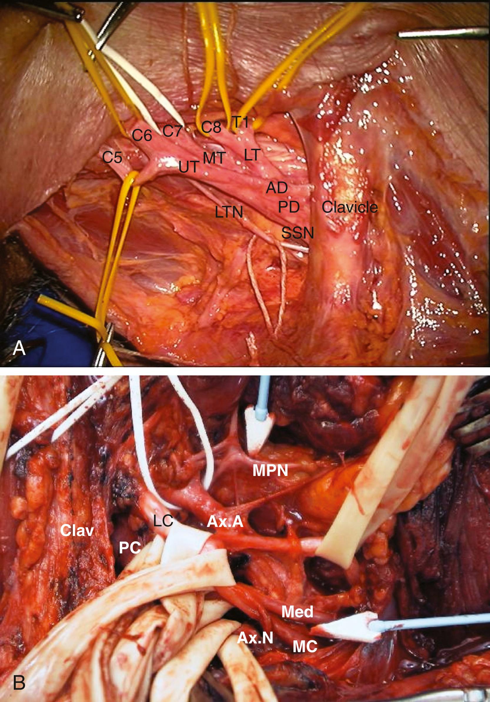 FIGURE 184.1, (A) Surgical anatomy of the right supraclavicular brachial plexus. The left side of the field is cephalad; the right, caudad. The superior aspect of the field is medial; the inferior, lateral. The C5 and C6 roots combine to form the upper trunk (UT) . C7 root continues as the middle trunk (MT) , while C8 and T1 roots combine to form the lower trunk (LT) . The upper trunk is seen to be further dividing into the anterior (AD) and posterior (PD) divisions, with the suprascapular nerve (SSN) arising near the bifurcation, forming a “trident.” The trajectory of the long thoracic nerve (LTN) is also visible, after resecting the medial scalene muscle. (B) Surgical anatomy of the right infraclavicular brachial plexus. To the left of the clavicle (Clav) is the supraclavicular plexus; to the right, infraclavicular. The superior aspect of the image is medial and the inferior is lateral. The lateral cord (LC) is seen dividing into the musculocutaneous (MC) nerve (arrow) and the lateral cord contribution to the median nerve (Med) . The axillary artery (Ax.A) is at the center of the field, surrounded by a vessel loop. The medial cord is posterior to the artery, although it is not seen here; however, the medial pectoral nerve (MPN, upper arrow) arising from this can be seen. Near the bottom of the field is the posterior cord (PC) and one of its outflows, the axillary nerve (Ax.N) .