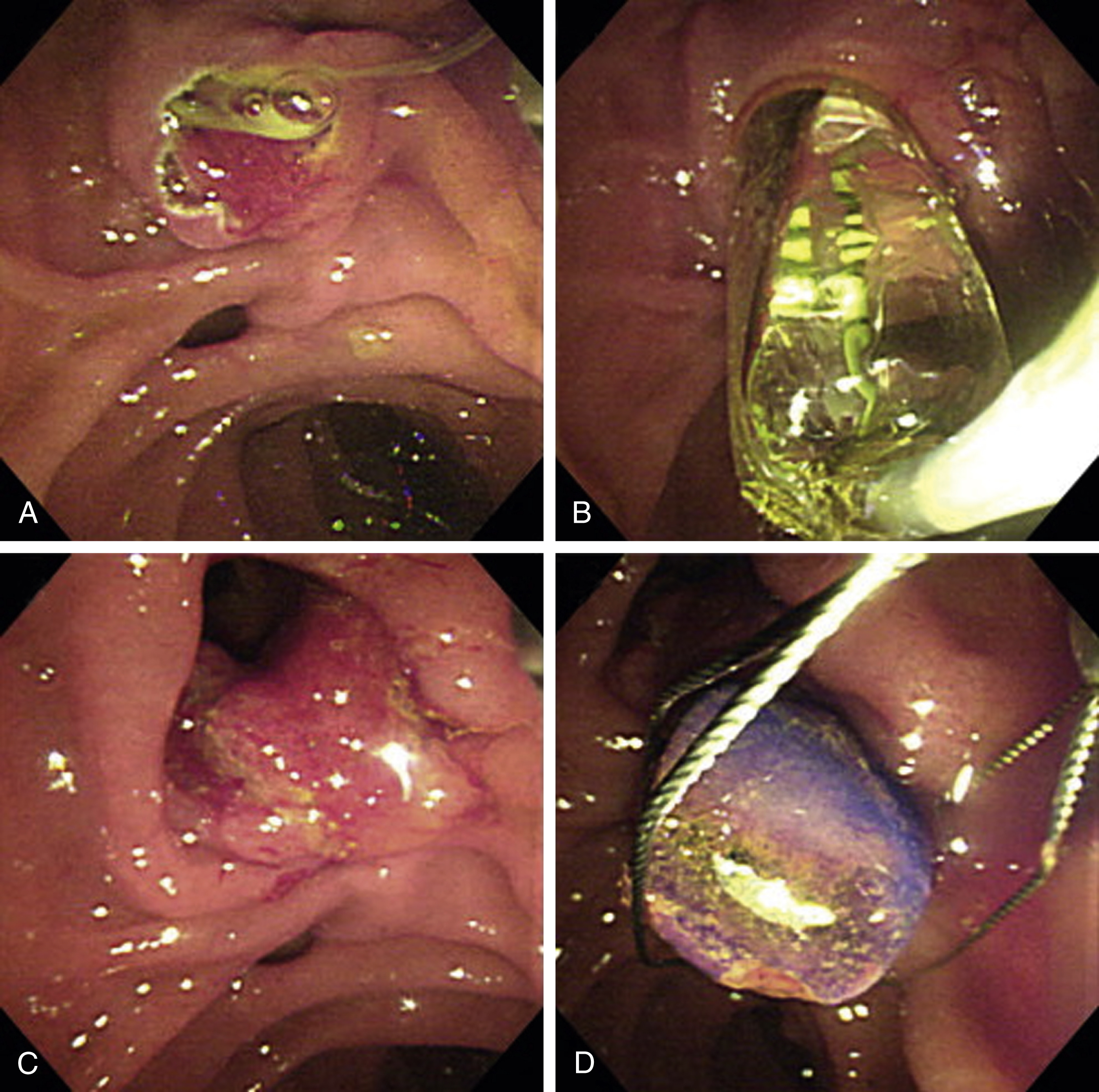 Fig. 96.1, Supplemental endoscopic papillary large balloon dilation. (A) Partial biliary sphincterotomy. (B) Papillary orifice is dilated with 12-mm-diameter balloon. (C) Large orifice is noted after the dilation. (D) The 12-mm stone is easily removed through the orifice.