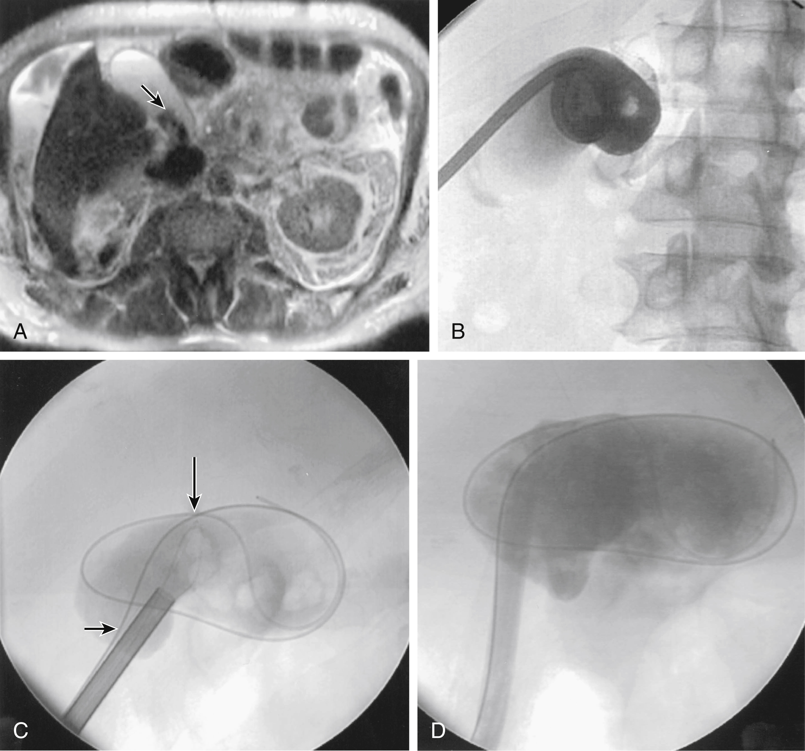 Fig. 96.2, Percutaneous access for cholecystolithotomy. (A) Preliminary T2-weighted magnetic resonance imaging demonstrates gallstones ( arrow ) in a nonsurgical candidate. (B) A 14F Cope loop catheter is placed and left to gravity drainage overnight. (C) Next morning, tract was dilated to 18F, and a basket was advanced. Note stone ensnared in basket ( long arrow ) and safety wire outside access sheath ( short arrow ). (D) Final cholangiography demonstrates clearance of stones. Tube was removed 4 weeks later.