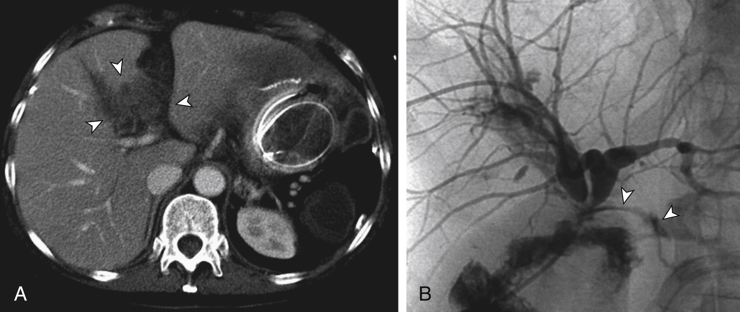 Fig. 94.2, This 64-year-old woman with pancreatic carcinoma underwent duodenopancreatectomy (Whipple technique). Persistent bilious effluence from abdominal drain and signs of bilious peritonitis occurred. (A) Abdominal computed tomography study revealed free fluid at porta hepatis ( arrowheads ). Because postoperative course was complicated by cardiac insufficiency, no repeat laparotomy was performed. (B) Percutaneous transhepatic cholangiography on postoperative day 8 showed leakage at bilioenteric anastomosis ( arrowheads ), with free spillage of contrast material into abdominal cavity. Right and left hepatic ducts were narrowed at site of anastomosis, probably because of edema.