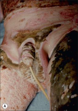 Fig. 55.2, (A) Burns of the penis are more commonly associated with injuries of the lower trunk and lower extremities. (B) Although skin grafts were used to achieve wound closure around the perineum, the major bulk of the penile wounds healed by secondary intention.