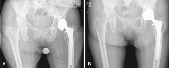 FIGURE 54.1, A, Anteroposterior radiograph of the pelvis of an 83-year-old woman who presented with a loose acetabular component and with medial and superior cavitary defects. B, Postoperative radiograph shows a larger acetabular component with superior bone grafting.