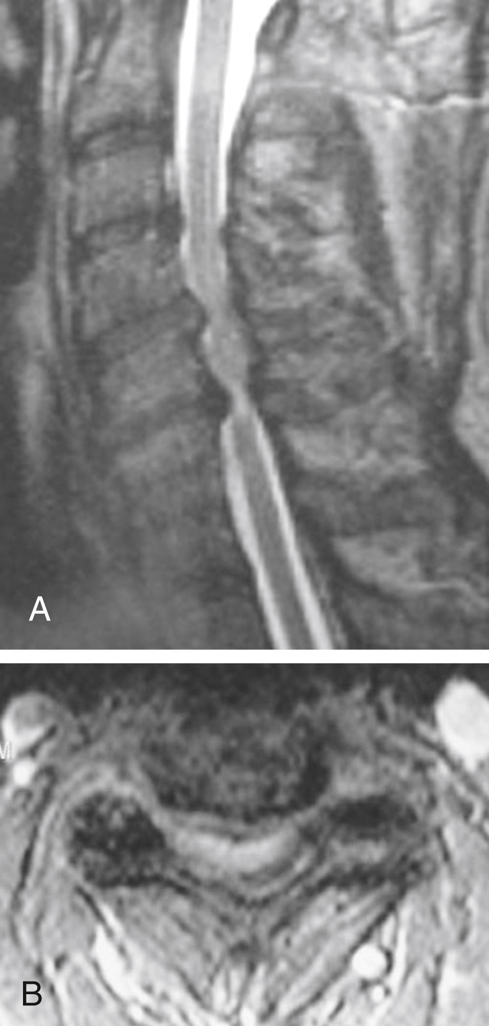 FIGURE 138.1, (A) Sagittal T2-weighted magnetic resonance image of the cervical spine. Significant circumferential stenosis of the cervical spinal canal is demonstrated. Multiple levels are involved, and there is straightening of the spine. The stenosis results from a combination of osteophyte formation, disc bulging, uncovertebral joint hypertrophy, and buckling of the facet capsule and ligamentum flavum. (B) Axial image of the same. The spinal cord has assumed a “Napoleon’s hat” configuration.