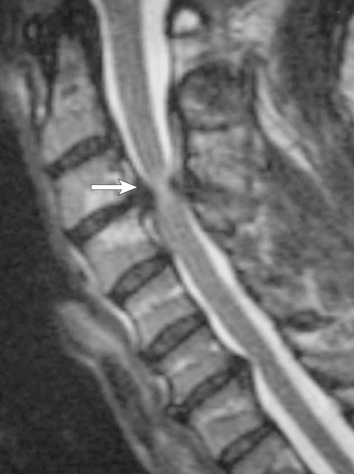 FIGURE 138.2, Sagittal T2-weighted magnetic resonance image of the cervical spine. Significant stenosis is demonstrated at the C3–C4 interspace. High signal intensity in the spinal cord in located at that level (white arrow) . This may indicate spinal cord contusion.