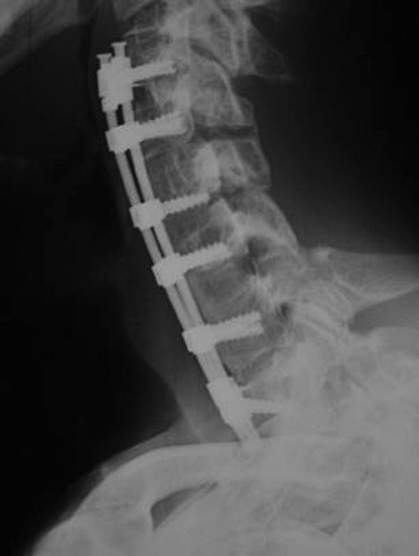 FIGURE 138.3, Lateral cervical radiograph of the cervical spine. The patient underwent multiple cervical discectomies and fusion versus one large contiguous corpectomy. This construct, which uses multiple points of intermediate fixation, has a theoretical mechanical and fusion potential advantage.