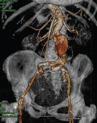 FIG 61.1, Challenging iliac access vessels.