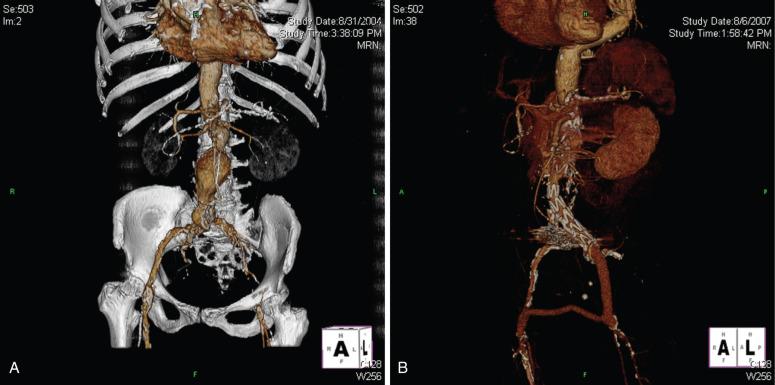 FIG 61.2, Open iliac conduit.