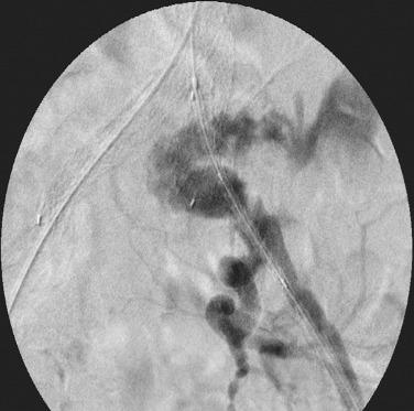 FIG 61.4, Retroperitoneal rupture after dilatation of the left iliac limb.