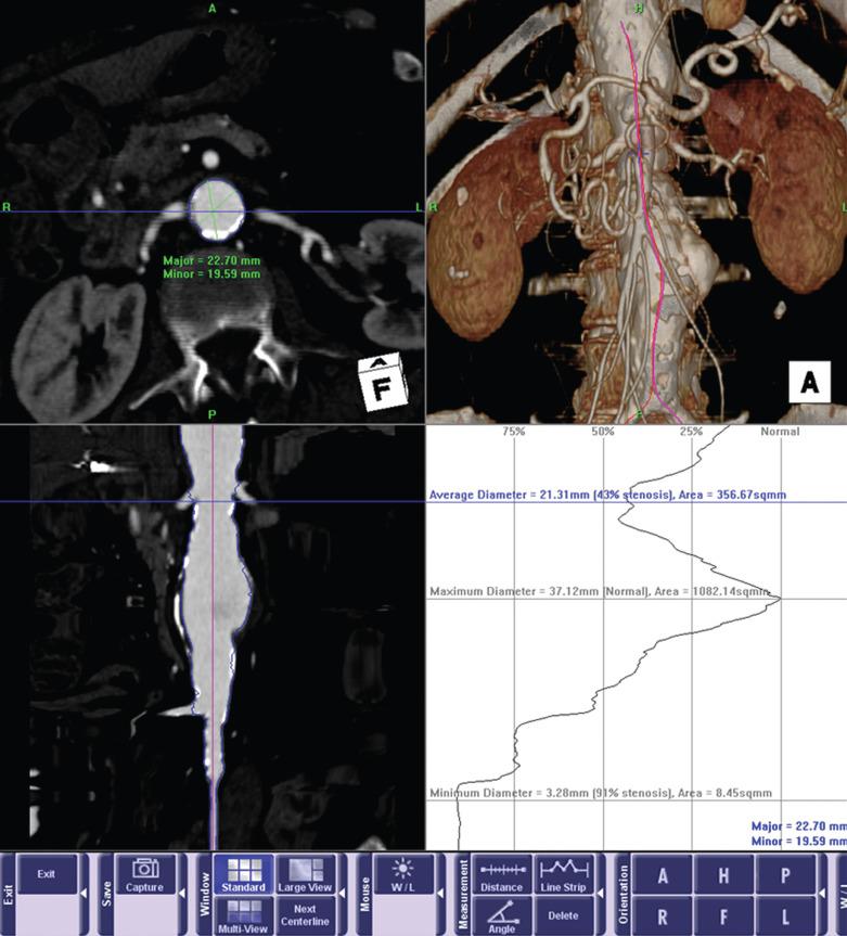 FIG 61.5, Three-dimensional computed tomographic reconstruction showing orthogonal, shaded surface and stretched views of the abdominal aorta.