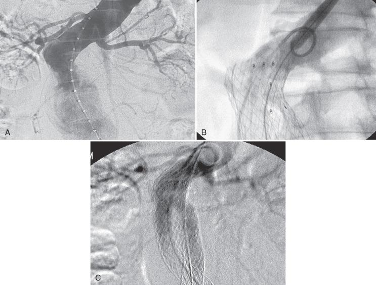 FIG 61.6, (A) Angled neck. (B) Deployment of the main body. The graft is low on the greater curve despite being just below the left renal on the lesser curve. This is primarily due to the stiffness of the device, which prevents it from conforming to the neck angulation. (C) Deployment of a proximal cuff allows for better coverage on the greater curve.