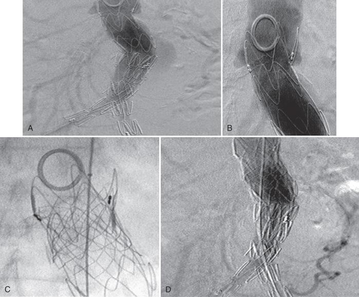 FIG 61.7, Neck irregularity treated with a large balloon expandable stent.