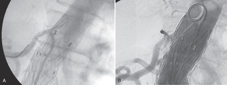 FIG 61.8, (A) Significant of a single renal artery by stent-graft fabric. Renal wire access has been obtained using a brachial approach. (B) Completion angiography after stent deployment demonstrates a widely patent renal artery.