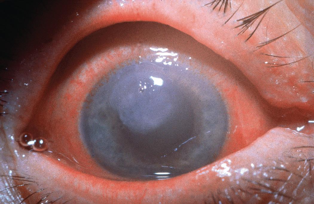 Fig. 17.2, Large Pseudomonas ulcer with corneal oedema.