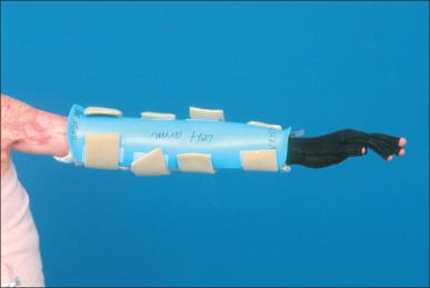 Fig. 53.2, A splint made of thermoplastic material is used to limit joint flexion.