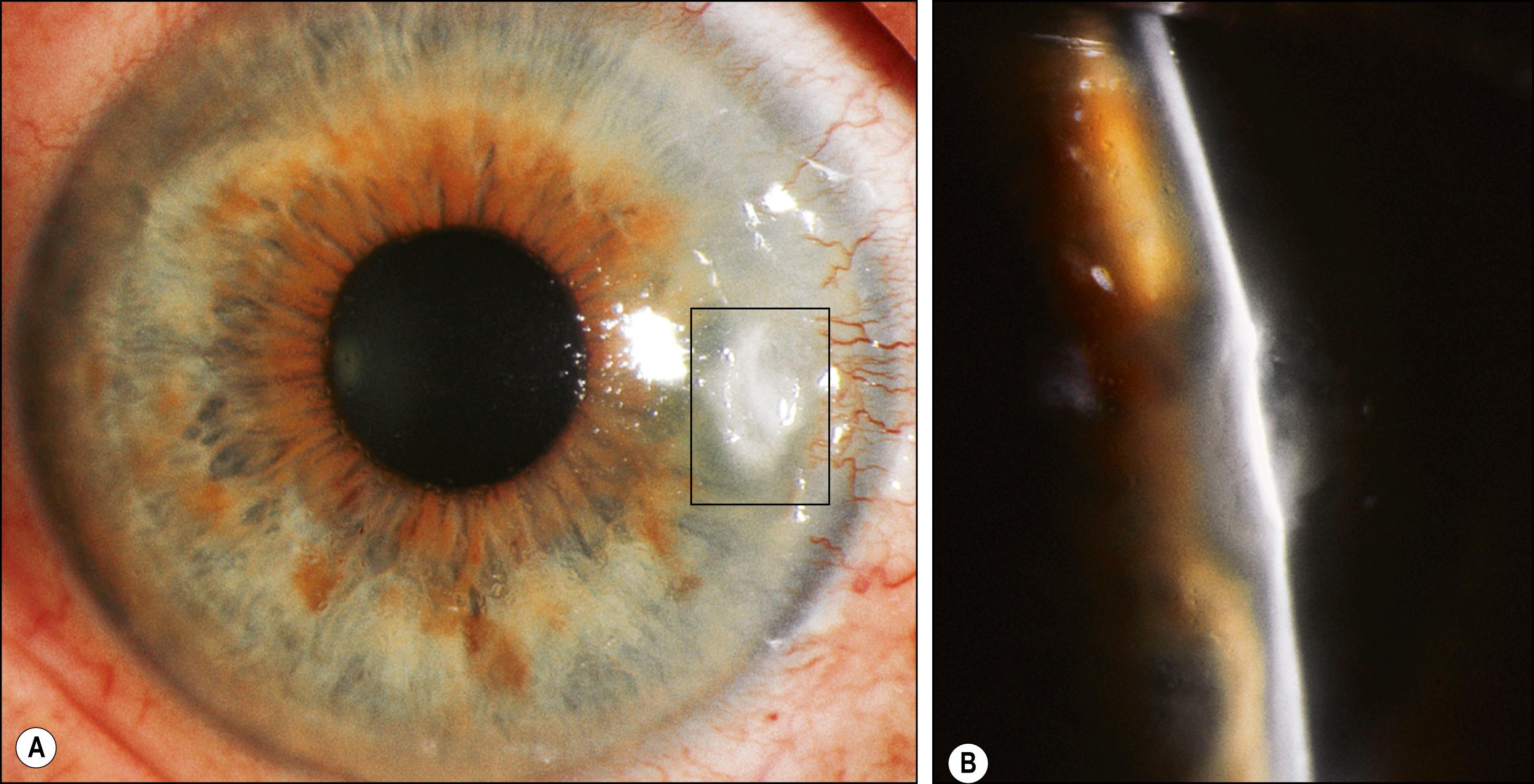 Fig. 140.1, ( A ) Peripheral corneal ulcer ( box ) in a patient with rheumatoid arthritis. ( B ) Slit lamp view demonstrating mild to moderate corneal thinning and stromal loss.