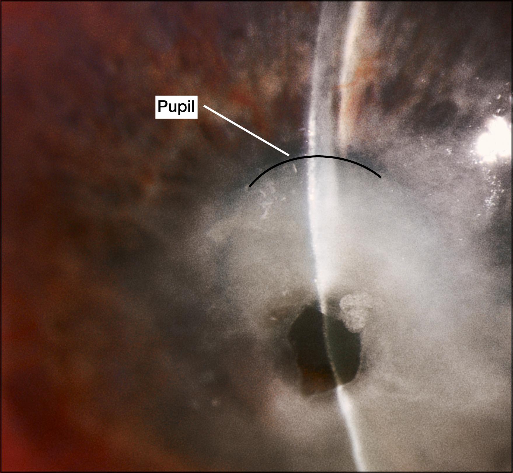 Fig. 140.2, Small central descemetocele within a large corneal ulcer. Note the slight bulge of Descemet membrane. The shallow anterior chamber indicates that this descemetocele is leaking slightly.