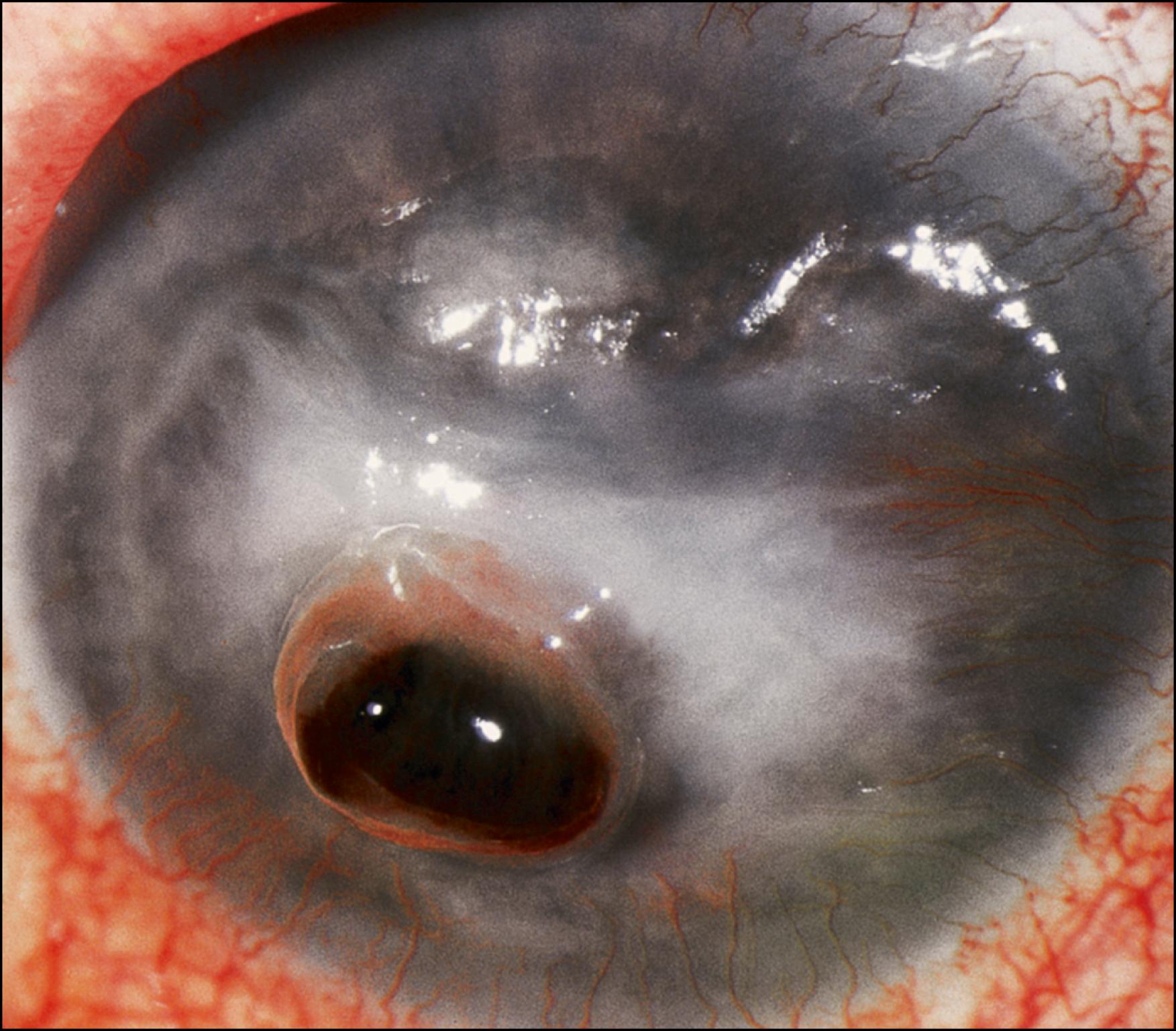 Fig. 140.3, Large area of iris prolapse covered with smooth, glistening, intact Descemet membrane in this eye with chronic corneal edema.