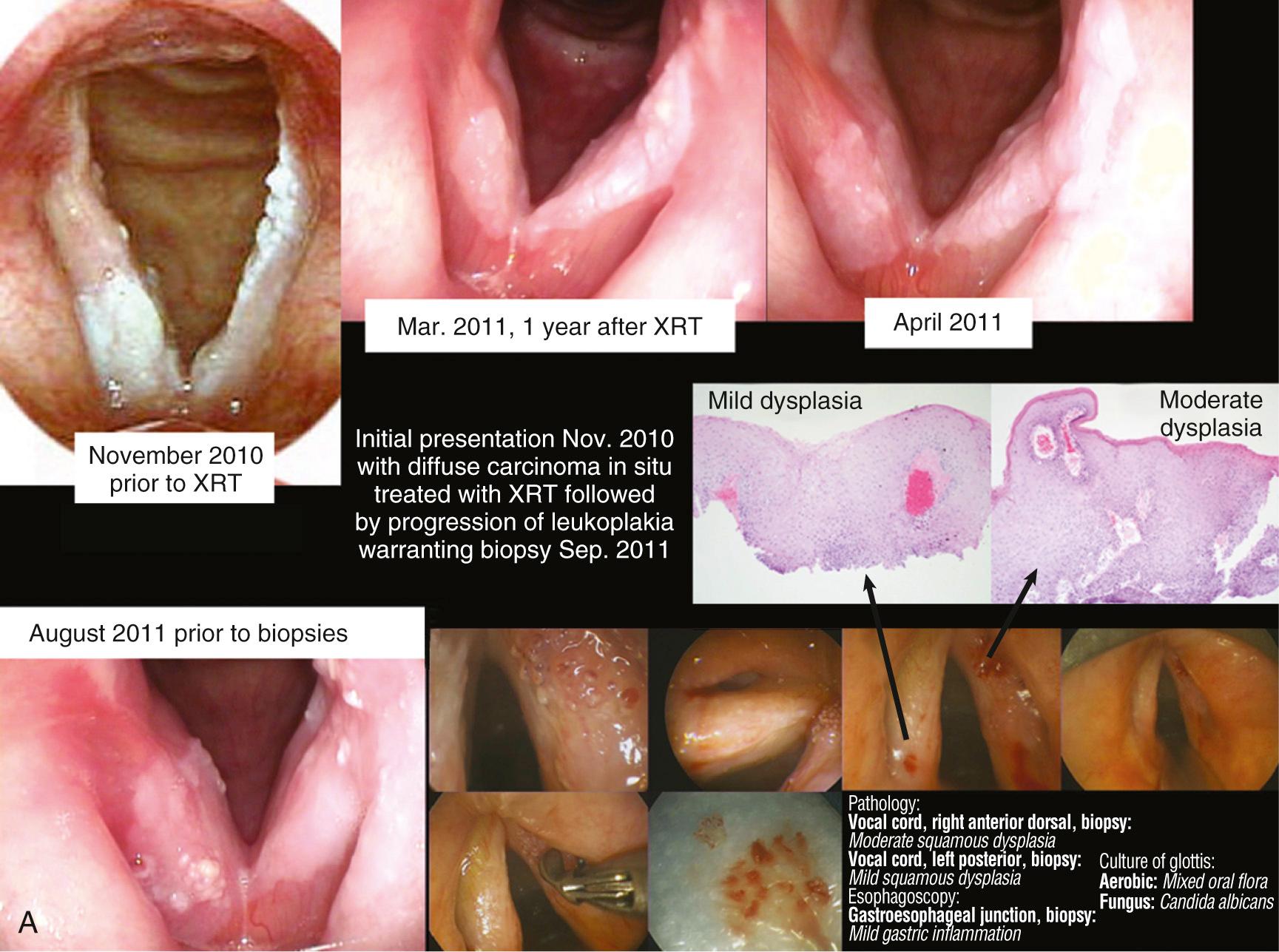 Fig. 106.1, (A) 67-year-old nonsmoker with 1 year of hoarseness was biopsied elsewhere with severe dysplasia identified and re-interpreted at the University of Iowa tumor board as carcinoma in situ. The extensive nature of the carcinoma, involving both vocal cords, warranted discussion of alternatives for treatment, with irradiation chosen. Close follow-up identified improvement but, with progression, repeat biopsies showed mild/moderate dysplasia with Candida cultured. (B) Continued follow-up showed progression following initial questionable improvement with antifungal medication. Successive efforts and endoscopic resections in March and April of 2013 were not successful in obtaining clear margins around extensive involvement of both true vocal cords extending to the supraglottis (false vocal cord) with carcinoma in situ. (C) Open supracricoid laryngectomy was indicated to resect diffusely positive CIS due to extent of disease and difficult access requiring the resection be done through the narrow Holinger anterior commissure laryngoscope. Final margins were clear with microinvasive cancer identified in both vocal cords and left false cord.