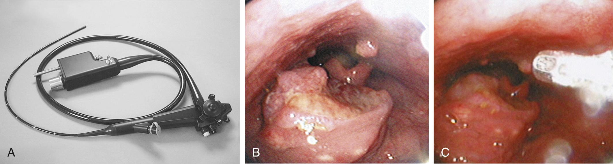 Fig. 106.2, (A) Transnasal esophagoscope (TNE) (Pentax). (B) View of oropharynx and hypopharynx through TNE. (C) Biopsy forceps prepared to remove posterior pharyngeal wall lesion.