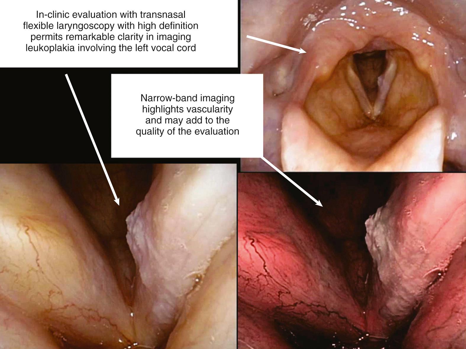 Fig. 106.3, Transnasal view of the larynx employing high-definition distal tipchip camera (Olympus) for an in-office examination of leukoplakia supplemented with narrow-beam imaging.