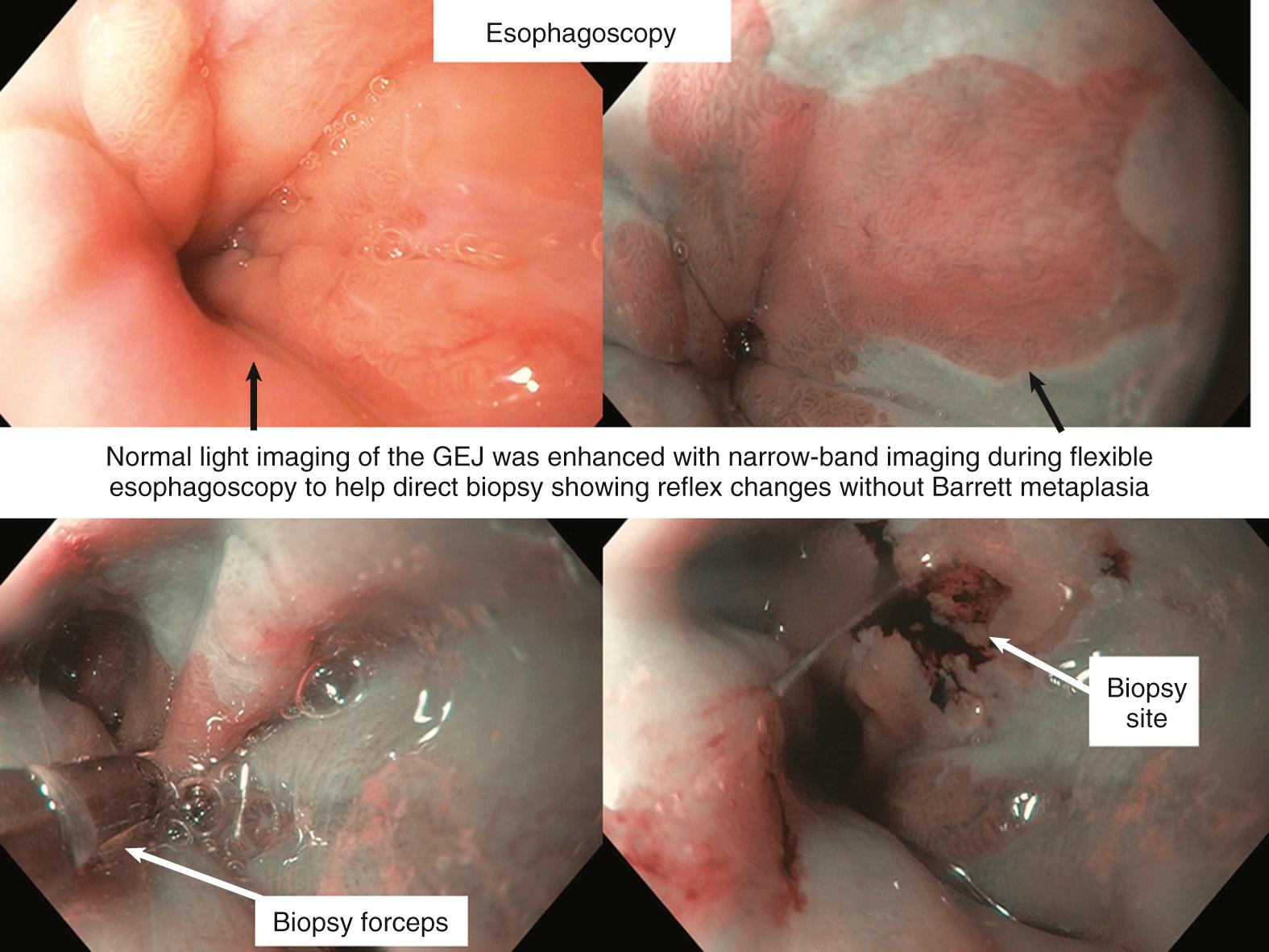 Fig. 106.4, Esophagoscopy demonstrating improved visualization of changes at the gastro-esophageal junction (GEJ) to direct biopsy with narrow-band imaging.