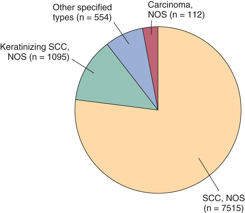 Fig. 106.5, Histology of laryngeal cancer cases diagnosed in 2000 National Cancer Database (NCDB).