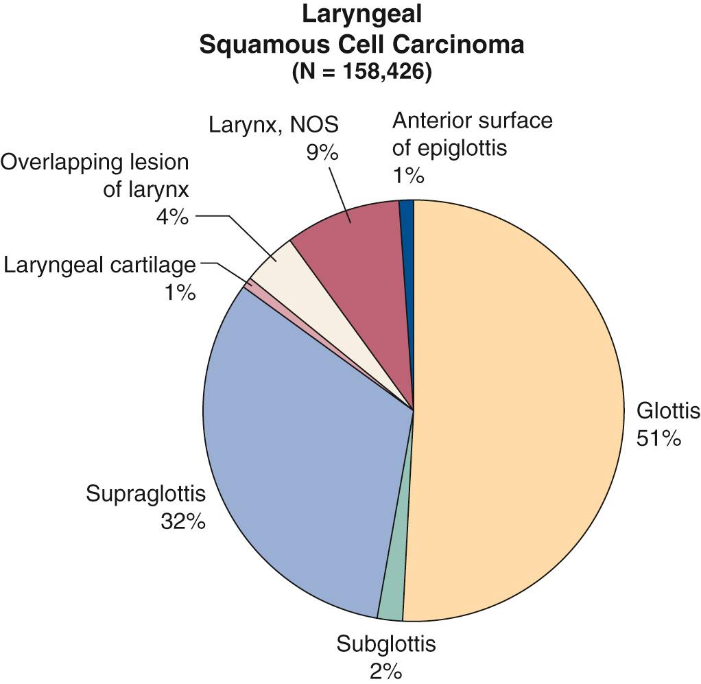 Fig. 106.6, Cancers isolated to the glottic larynx account for approximately one-half of all laryngeal cancer cases in the United States.