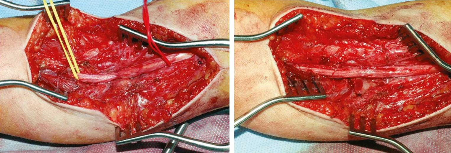 FIGURE 188.2, Median nerve compressed after supracondylar fracture in a 7-year-old child. The patient was referred because of lack of recovery after 3 months from the trauma. Note the shape of the median nerve immediately after the release of the constriction and then at the end of the procedure 15 minutes later. The nerve has already regained a more normal shape and the indentation was no longer present.