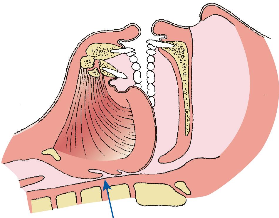 Fig. 25.1, Posterior displacement of tongue and occlusion of upper airway resulting from bilateral mandibular fractures.