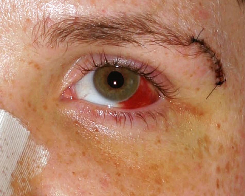 Fig. 25.3, Periorbital ecchymosis and lateral subconjunctival hemorrhage associated with zygomatic complex fracture.