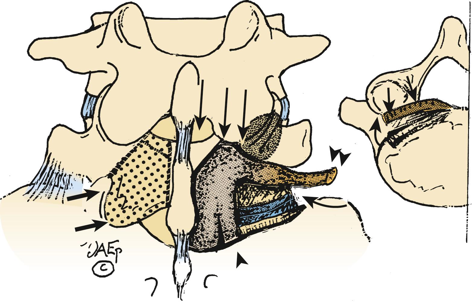 FIGURE 147.4, Full facetectomy for excision of lateral, foraminal, and far lateral type IIIB calcified limbus vertebral fracture is illustrated. A right-sided hemilaminectomy with medial facetectomy at the L4–5 level (triple arrows) combined with a full facetectomy at the L5–S1 level provides adequate visualization of the superior, foraminal, and far lateral exiting L5 nerve root (small double arrowheads) as it is tethered over a lateral, foraminal, and far lateral type IIIB calcified limbus vertebral fracture (curved arrow ). A transaxial view on the right demonstrates the critical foraminal location of the limbus fracture (single arrow) . Also observe the extent of L5 laminar resection illustrated to the far left (double arrows) .