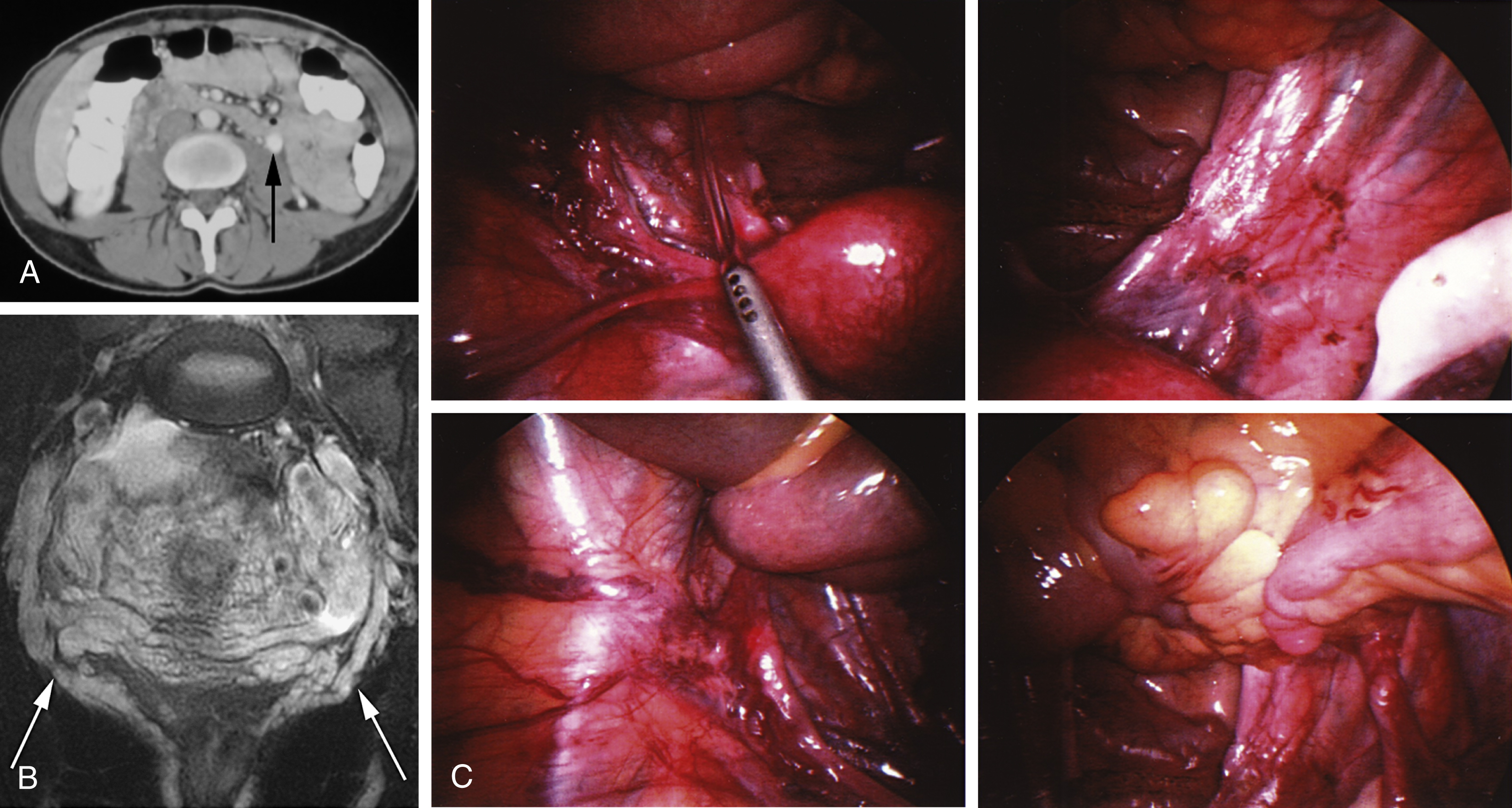 Fig. 47.1, (A) Postcontrast axial computed tomography image shows dilated incompetent left ovarian vein ( arrow ). (B) Coronal T2-weighted magnetic resonance image shows significant pelvic varices ( arrows ) around uterus. (C) Images from direct laparoscopic examination show pelvic varices around uterus.