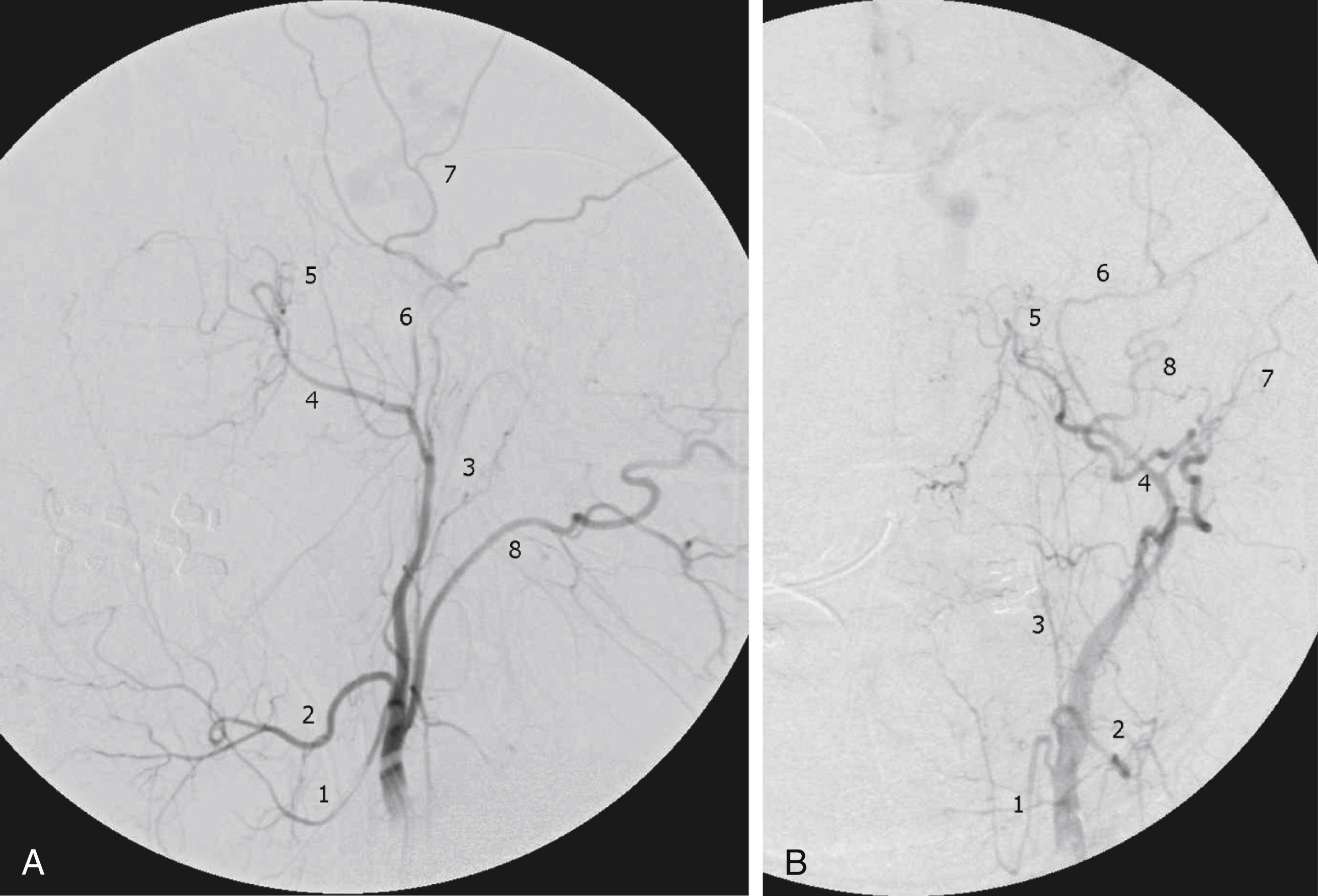 Fig. 66.2, Lateral (A) and anteroposterior (B) angiograms of external carotid artery demonstrate main branches, including ( 1 ) lingual artery, ( 2 ) facial artery, ( 3 ) ascending pharyngeal artery, ( 4 ) internal maxillary artery, ( 5 ) sphenopalatine artery, ( 6 ) middle meningeal artery, (7) superficial temporal artery, and ( 8 ) occipital artery.