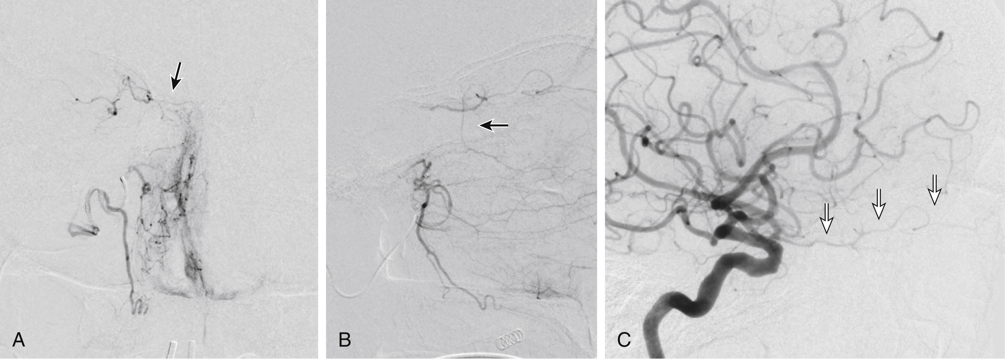 Fig. 66.3, Left external carotid artery (ECA) anteroposterior (A) and lateral (B) angiograms, and left internal carotid artery (ICA) lateral (C) angiogram reveal anastomosis between distal internal maxillary artery and ophthalmic artery (OphA) ( black arrow ) via posterior ethmoidal artery collaterals. Note retrograde filling of OphA; identical vessel morphology is seen on ICA injection ( white arrows ).