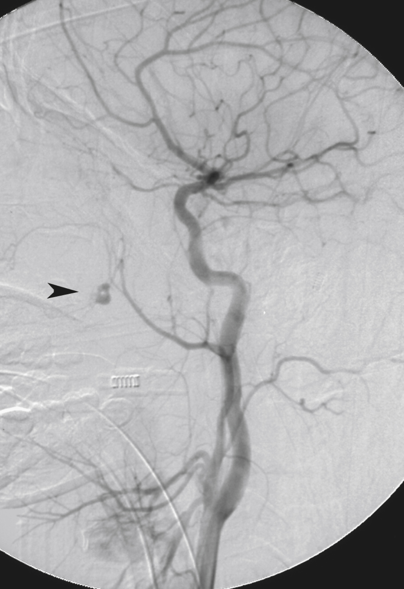 Fig. 66.4, Lateral external carotid artery angiogram demonstrating a small pseudoaneurysm ( arrowhead ) arising from a branch of internal maxillary artery.