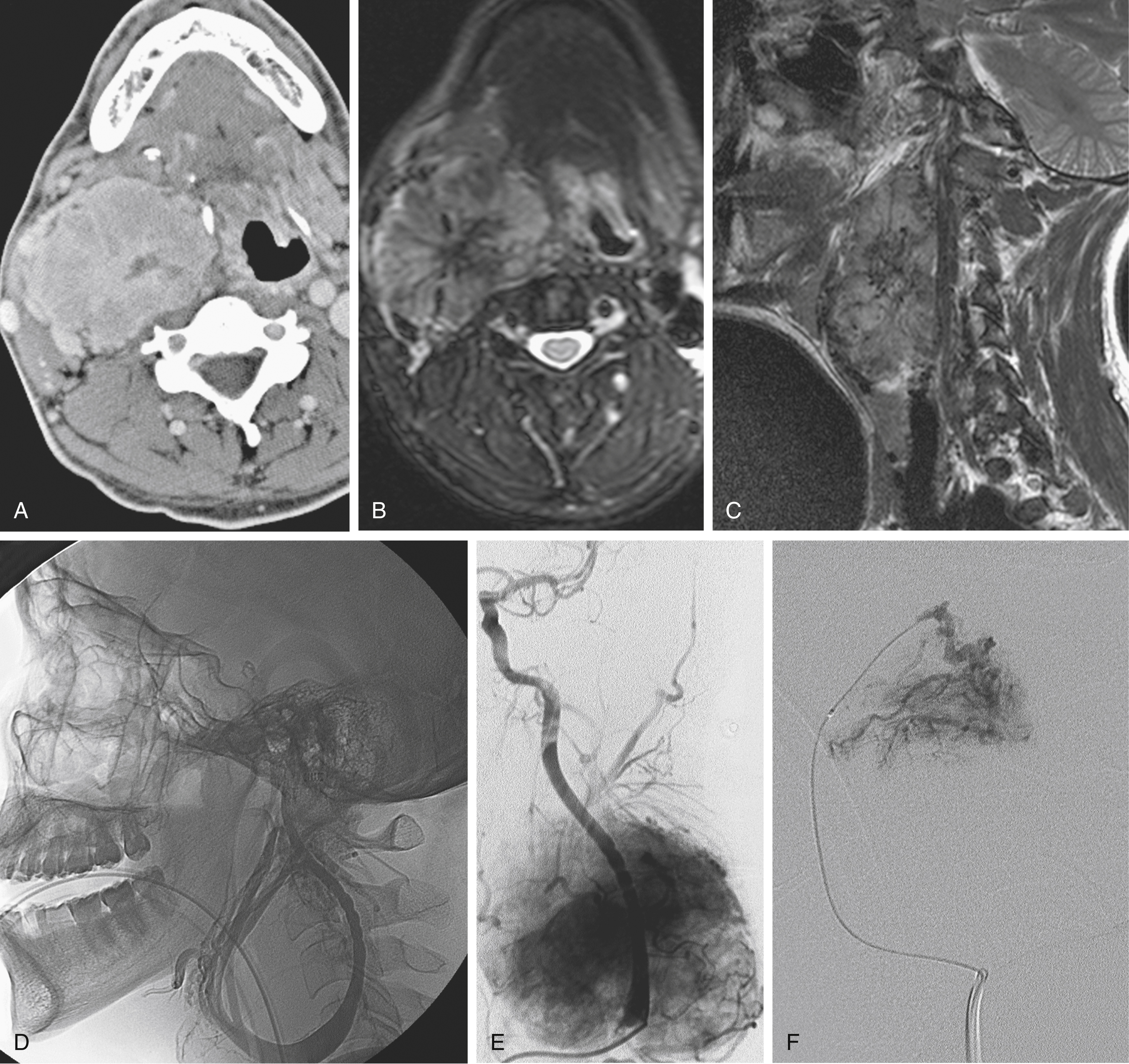 Fig. 63.1, Carotid body tumor. (A) Axial contrast-enhanced computed tomography scan demonstrating large enhancing mass deviating airway. Vessels of carotid sheath are splayed. (B) Axial Fat Sat T2-weighted fast spin-echo (FSE) magnetic resonance imaging (MRI) demonstrating same findings with flow-related signal voids seen within central tumor. (C) Sagittal Fat Sat FSE T2-weighted MRI demonstrating flow-related signal voids within mass centered on carotid sheath. (D) Lateral angiogram demonstrating splayed external and internal carotid arteries. (E) Capillary phase from same angiogram in anteroposterior view demonstrating diffuse capillary blush. (F) Lateral angiogram taken with a coaxial microcatheter and guide demonstrating multicompartmental blood supply. This technique was used to deliver polyvinyl alcohol particles 150 to 250 μm in size to each feeding vessel. Immediate surgical resection followed.