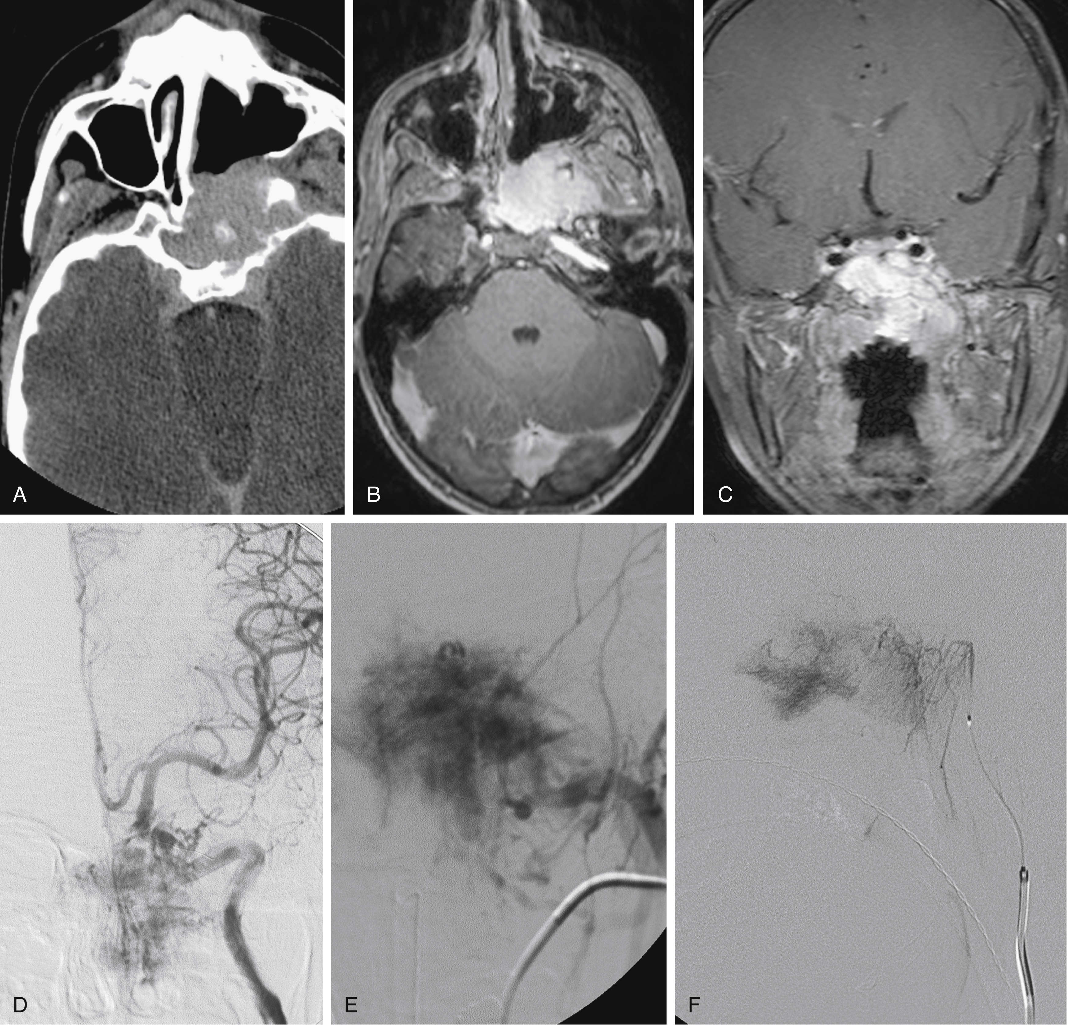 Fig. 63.2, Juvenile nasopharyngeal angiofibroma. (A) Axial contrast-enhanced computed tomography scan demonstrating an enhancing mass expanding pterygopalatine fossa and extending through foramina. Foramina are expanded and bone is eroded. (B) Axial contrast-enhanced magnetic resonance imaging (MRI) demonstrating similar findings. (C) Coronal contrast-enhanced MRI with fat suppression demonstrating tumor extent relative to skull base. (D) Anteroposterior (AP) angiogram demonstrating internal carotid arterial supply and tumor blush. (E) AP angiogram with a 4F H1 catheter injecting left internal maxillary artery, causing intense tumor blush. (F) Lateral angiogram demonstrating coaxial microcatheter and guide used to inject ascending pharyngeal artery. This technique was used to deliver 150- to 250-μm polyvinyl alcohol particles to bilateral external carotid artery branches feeding tumor. Immediate surgical resection followed.