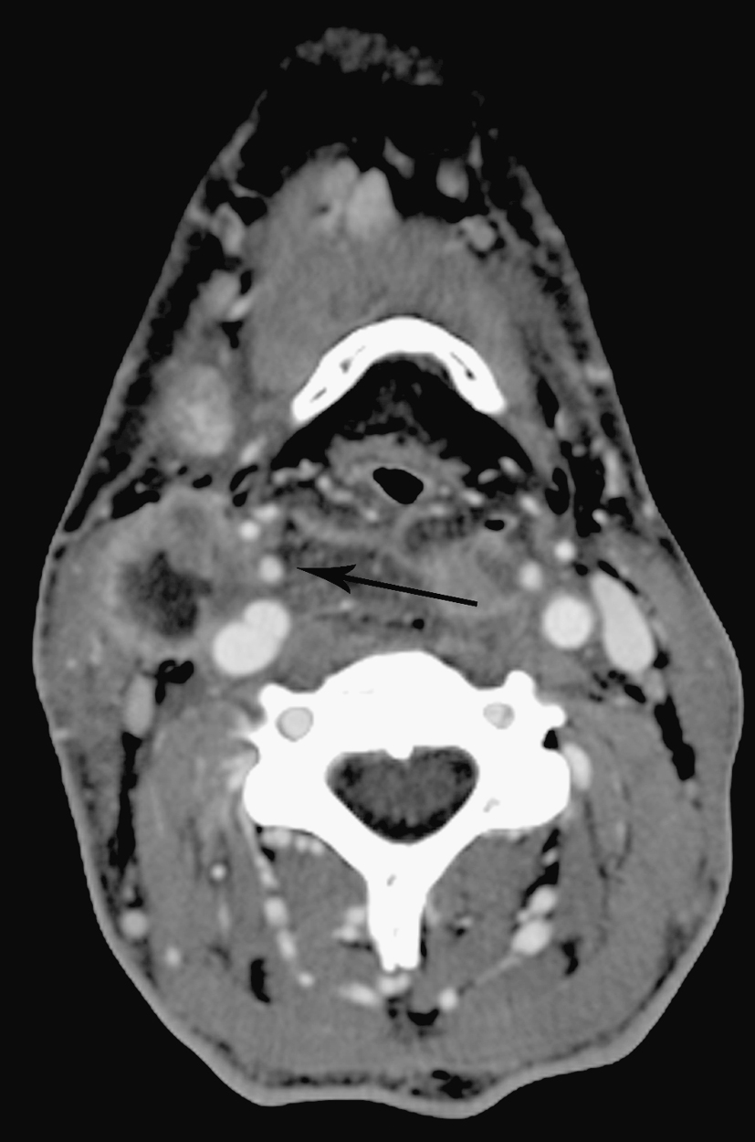 Fig. 63.4, Axial contrast agent-enhanced computed tomography scan of tumor invading carotid artery. Arrow indicates necrotic tumor surrounding internal carotid artery (ICA) (right ICA with > 200-degree circumferential involvement). There is high likelihood of carotid invasion by tumor.