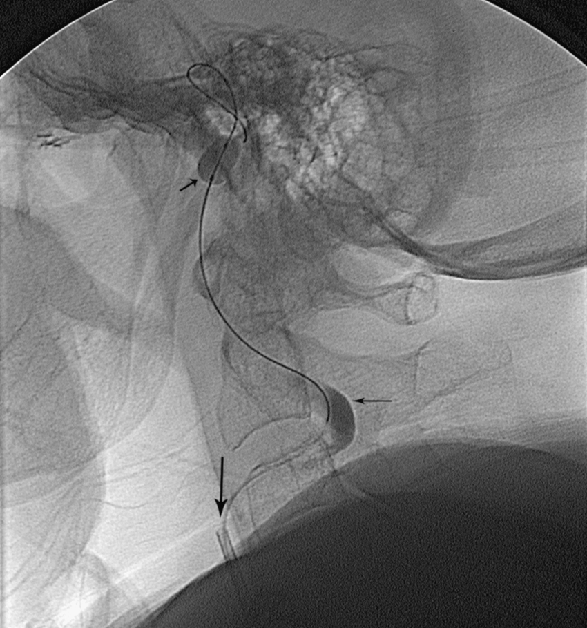 Fig. 63.5, Balloon test occlusion. Lateral view from angiogram demonstrates occlusive balloon in distal internal carotid artery (oblique arrow ). Horizontal arrow indicates stagnant contrast material in carotid bulb. Vertical arrow indicates guiding catheter in distal common carotid artery.