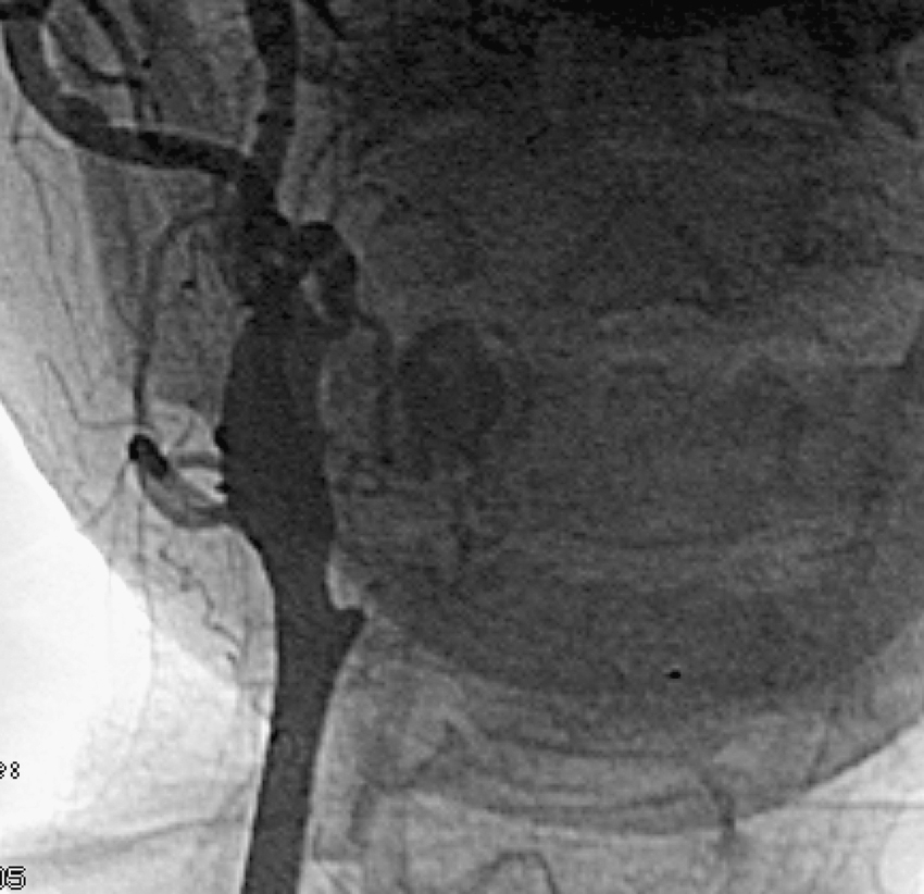 Fig. 63.6, Damage to carotid artery by tumor and therapy. Anteroposterior angiogram demonstrates severe irregularity of internal and external carotid arteries.